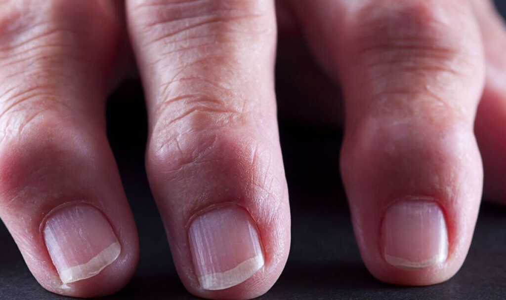 Man 83 Develops paresthesia In His Fingers Due To extreme Vitamin 