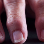Man 83 Develops paresthesia In His Fingers Due To extreme Vitamin