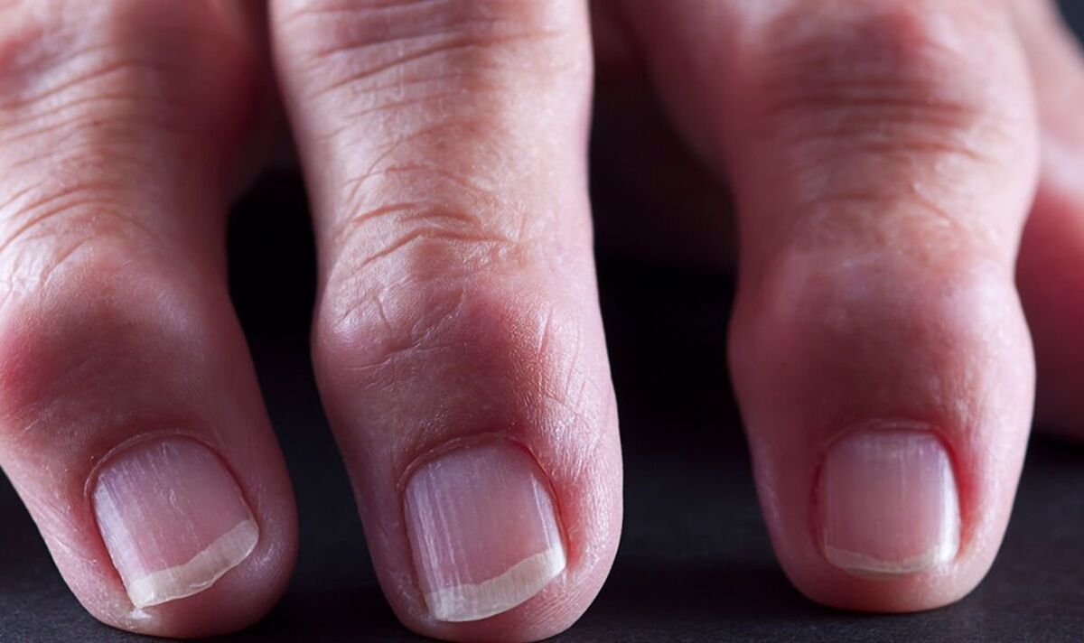 Man 83 Develops paresthesia In His Fingers Due To extreme Vitamin